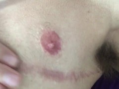 FtM Chest Scar Massage