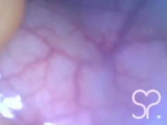 Anal Endoscope all the way in my Transverse Colon – Full Video on Manyvids and Fansly